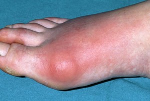 PRinc_photo_of_inflamed_gout_toe