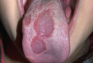Ulcer3